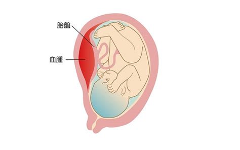 胎盤剝離後期|常位胎盤早期剥離とは？症状や兆候・原因は？